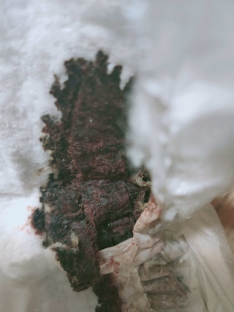 レバー状のオリモノと血液